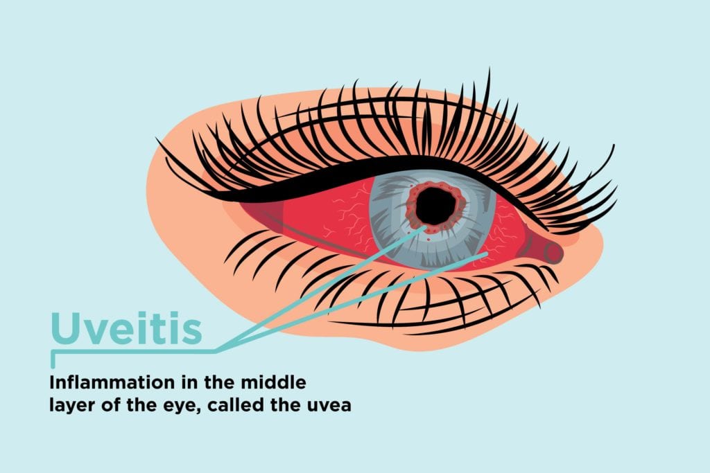 uveitis-and-arthritis-how-inflammation-can-affect-your-eyes-18luck